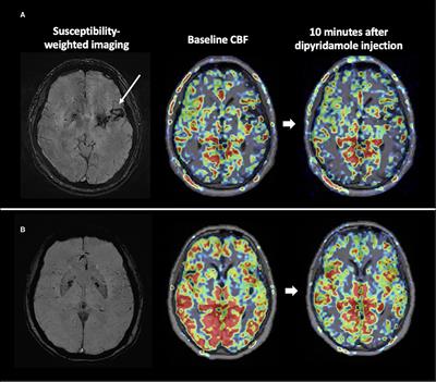 Arterial Spin Labeling Imaging Assessment of Cerebrovascular Reactivity in Hypertensive Small Vessel Disease